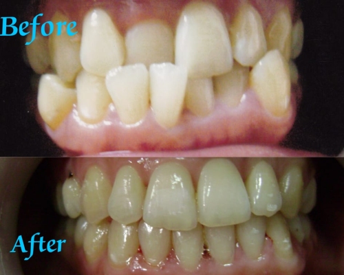 Rekomendasi Pasang Imolan Gigi Terpercaya Sanafa Dental Clinic
