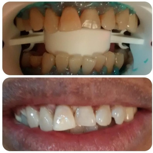Lokasi Pasang Imolan Gigi Termurah Sanafa Dental Clinic