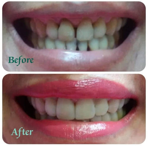 Rekomendasi Scalling Gigi Aman Sanafa Dental Clinic