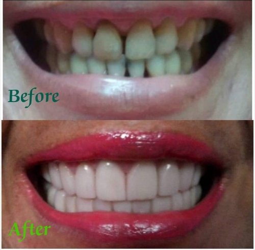 Rekomendasi Pasang Kawat Gigi Terpercaya Sanafa Dental Clinic